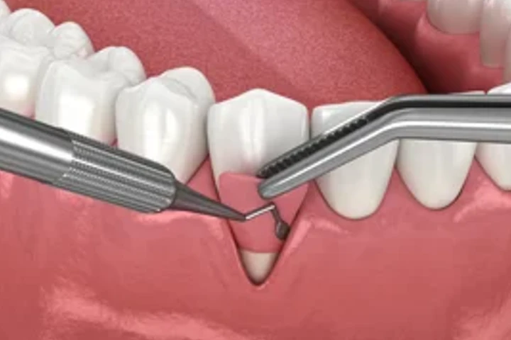 Oralchirurgie – operativer Eingriff am Zahnfleischsaum mit Instrumenten