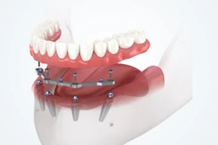 Implantologie – implantatgetragene Versorgung im Unterkiefer
