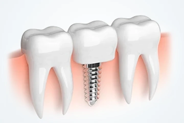 Prothetik – Krone auf einem Implantat zwischen zwei natürlichen Zähnen