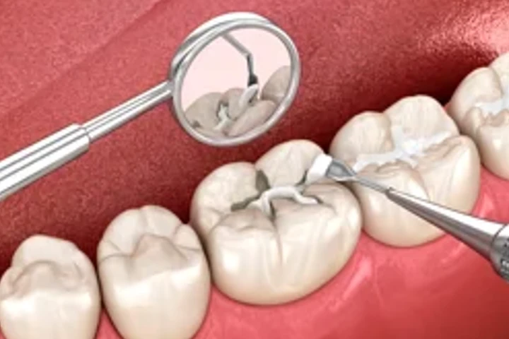 Endodontie – Behandlung eines Zahns mit Mundspiegel und Instrument