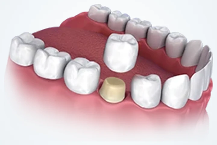 Veneers – Keramikschale im Vergleich zum natürlichen Zahn im Oberkiefer